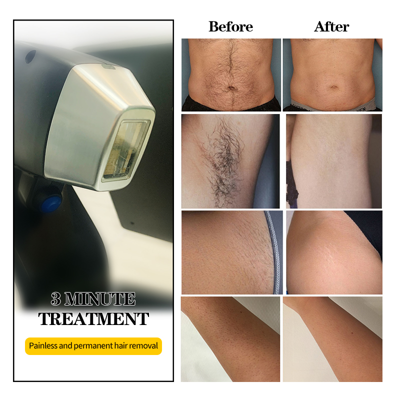 Titanium Diode Laser Hair Removal Machine